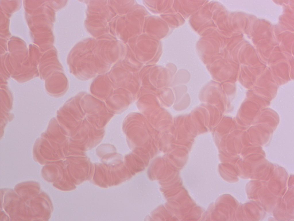 Canlı Su Nedir? 4 Vucudunda tumor bulunan 42 yasinda bir hasta sudan once